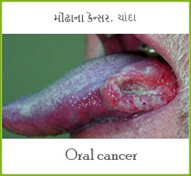 Jaw fracture in Mehsana