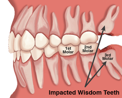 impected wisdom teeth
